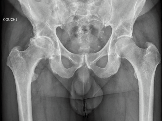 Arthrose hanche 