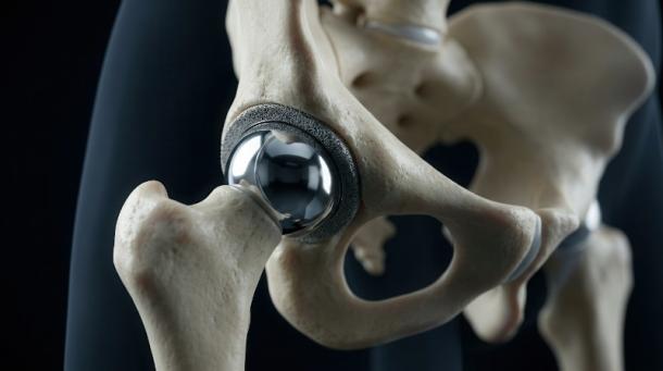 implant de hanche implant de hanche